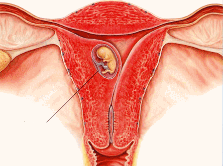 Endometrial Receptivity Array (ERA) For Repeated Failure of Pregnancy